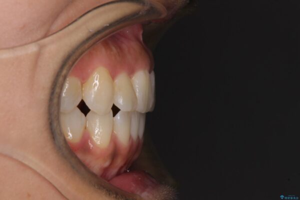 【モニター】幅の狭い上顎歯列　骨幅を拡大する矯正治療 治療後画像
