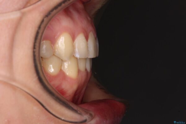 【モニター】前歯のデコボコと奥歯の虫歯　インビザライン治療と奥歯のセラミック治療 治療後画像