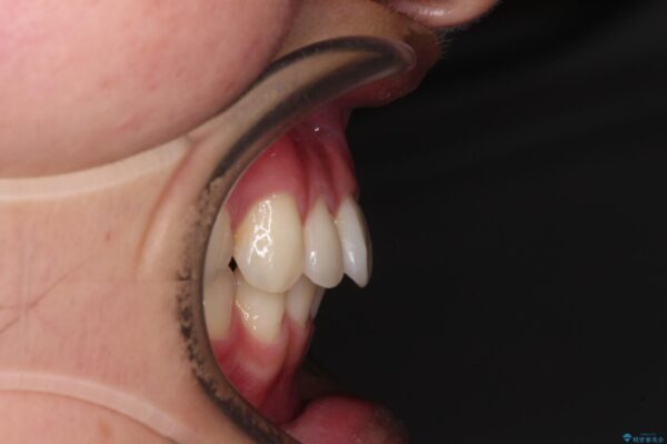 【モニター】犬歯のクロスバイトを目立たないワイヤー装置で 治療後画像