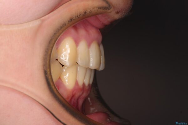 上下前歯のデコボコをきれいに　インビザラインによる矯正治療 治療後画像