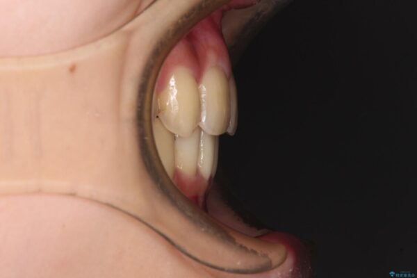 出っ歯を治したい　ワイヤー装置による抜歯矯正 アフター