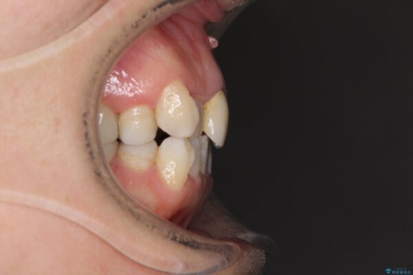 奥歯の銀歯と歯並びを改善　歯周外科治療と矯正治療を行った総合歯科診療 治療途中画像