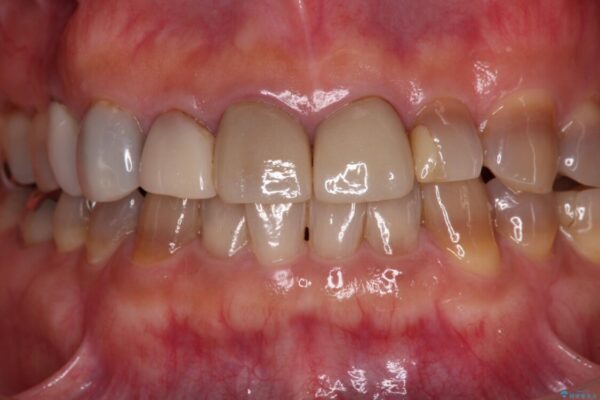 テトラサイクリン歯をオールセラミッククラウンで審美的に 治療前画像