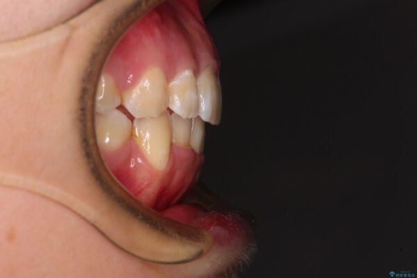 前歯の出っ歯と口の閉じにくさを抜歯矯正で改善　目立たないワイヤー矯正 治療後画像