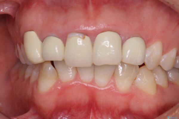 不揃いな前歯のセラミックが気になる　オールセラミッククラウンによる補綴治療 治療前画像