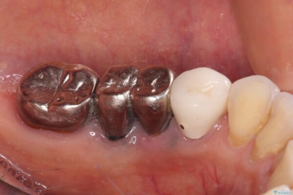 抜かずに保存した奥歯が痛くて臭う　セラミックブリッジによる欠損補綴治療 治療前画像