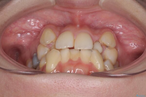 結婚式までに前歯をきれいにしたい　抜歯矯正とオールセラミッククラウン 治療前画像
