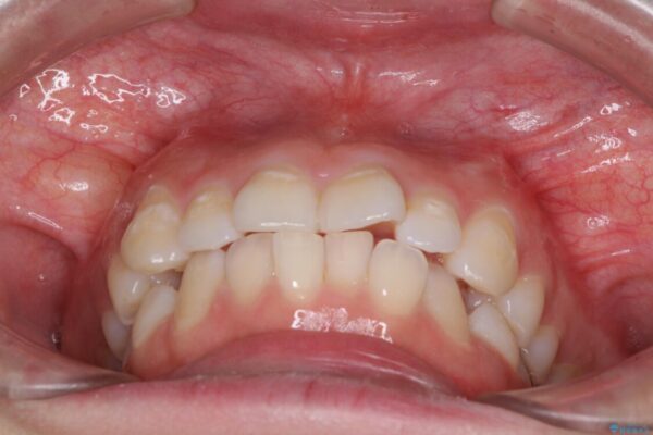 ふっくらとした口元を改善したい　目立たないワイヤー装置による抜歯矯正 治療前画像