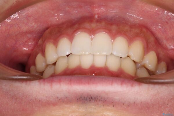 前歯のデコボコと突出感　インビザラインにて矯正治療 治療後画像