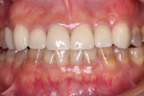 テトラサイクリン歯をオールセラミッククラウンで審美的に 治療後画像