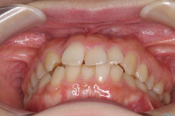 変則的な抜歯矯正　八重歯を抜いてしまった人のワイヤー矯正 治療前画像