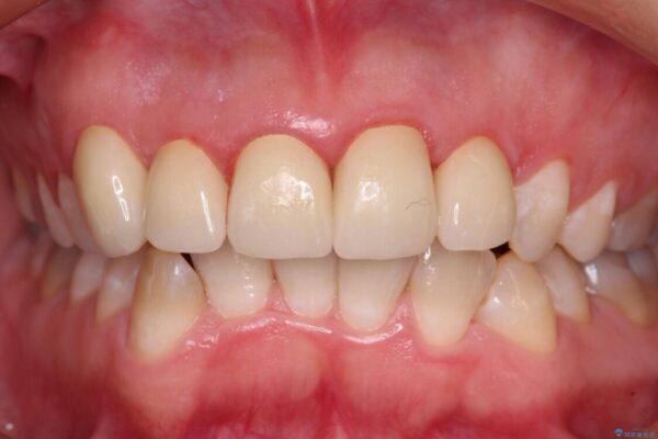 不揃いな前歯のセラミックが気になる　オールセラミッククラウンによる補綴治療 治療後画像
