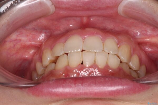 変則的な抜歯矯正　八重歯を抜いてしまった人のワイヤー矯正 治療後画像