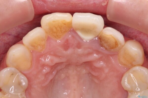 横から見た時の歯の色が違いすぎる　前歯のオールセラミッククラウン 治療前画像