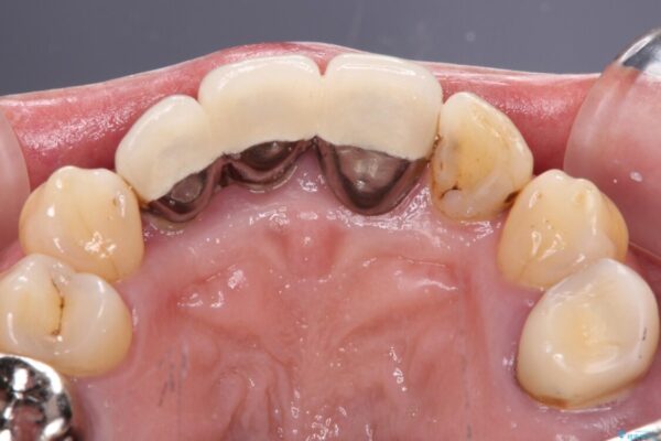 歯茎の縁に見える変色を隠したい　前歯のオールセラミッククラウン 治療前画像