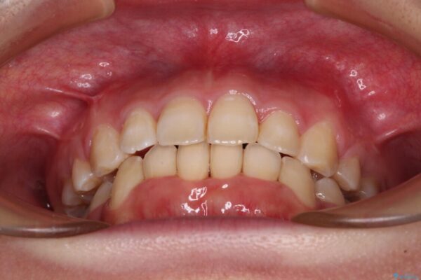 前歯の出っ歯と口の閉じにくさを抜歯矯正で改善　目立たないワイヤー矯正 治療後画像