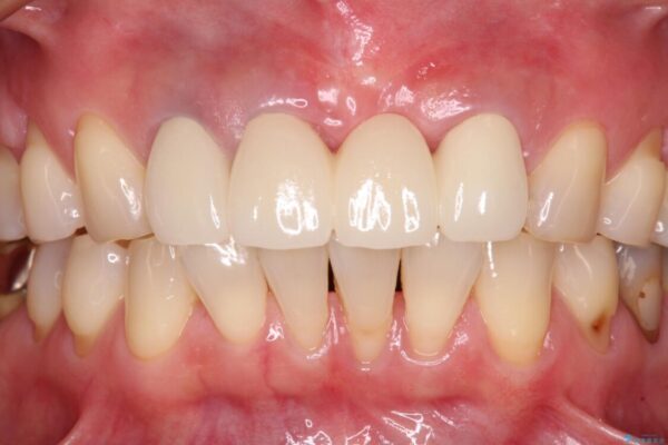 抜かなければいけない前歯　歯肉移植を用いたオールセラミックブリッジ 治療後画像
