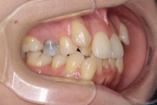 結婚式までに前歯をきれいにしたい　抜歯矯正とオールセラミッククラウン 治療前画像