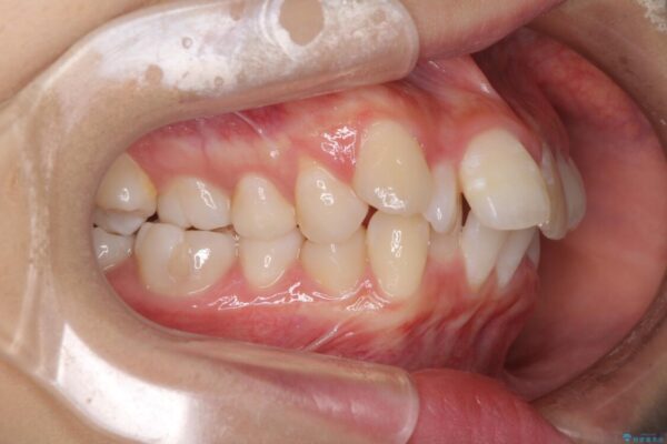 口元の突出感を改善　2年弱での抜歯矯正 治療前画像