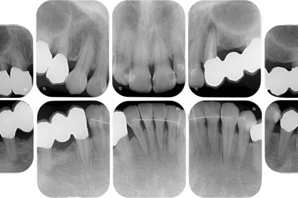 歯並びや奥歯の痛み　色々と治したい　総合歯科診療 治療後画像