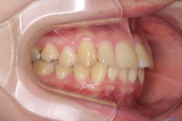 上下前歯のデコボコをきれいに　インビザラインによる矯正治療 治療前画像