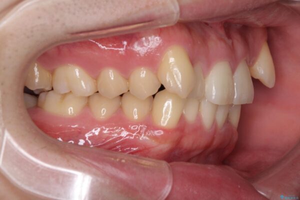 気になる八重歯を抜歯矯正で改善　補助装置を用いたインビザライン矯正 治療前画像