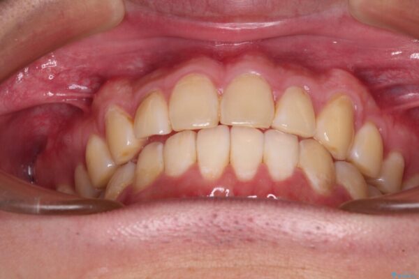 気になる前歯を治したい　短期間でのインビザライン矯正 治療後画像