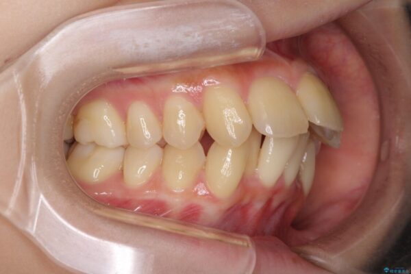出っ歯を治したい　ワイヤー装置による抜歯矯正 治療前画像