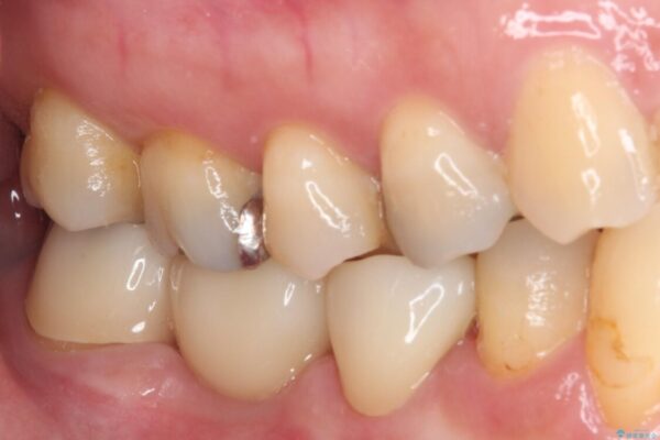 インプラントしかないと言われた　奥歯のオールセラミックブリッジ 治療後画像