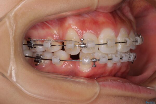 口元の突出感を改善　2年弱での抜歯矯正 治療途中画像