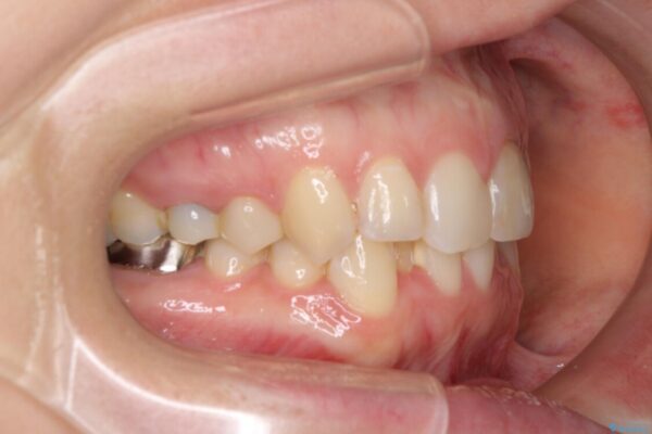 【モニター】前歯のデコボコと奥歯の虫歯　インビザライン治療と奥歯のセラミック治療 治療前画像