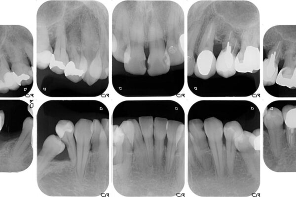 歯並びや奥歯の痛み　色々と治したい　総合歯科診療 治療前画像
