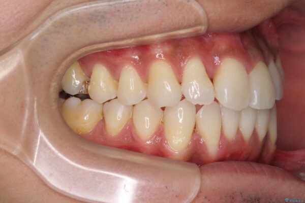 上顎の狭い歯列をインビザラインで拡大 治療途中画像