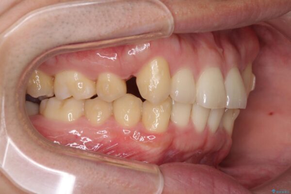 気になる八重歯を抜歯矯正で改善　補助装置を用いたインビザライン矯正 治療途中画像