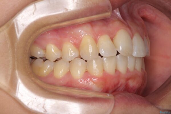 前歯のデコボコをインビザラインでスッキリと仕上げる 治療途中画像