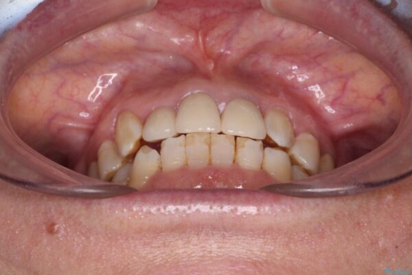奥歯の銀歯と歯並びを改善　歯周外科治療と矯正治療を行った総合歯科診療 治療後画像