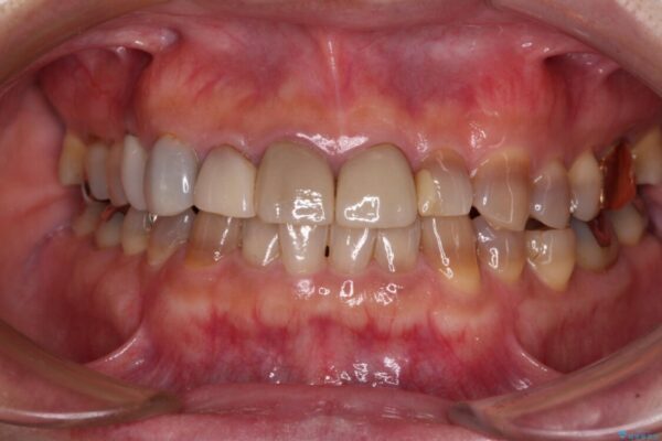 テトラサイクリン歯をオールセラミッククラウンで審美的に 治療前画像