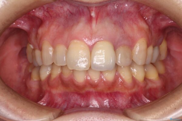 横から見た時の歯の色が違いすぎる　前歯のオールセラミッククラウン 治療前画像