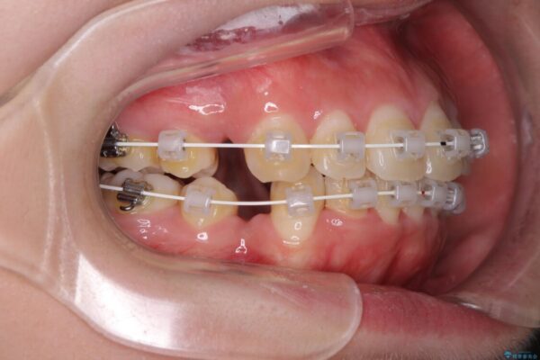 前歯の出っ歯と口の閉じにくさを抜歯矯正で改善　目立たないワイヤー矯正 治療途中画像