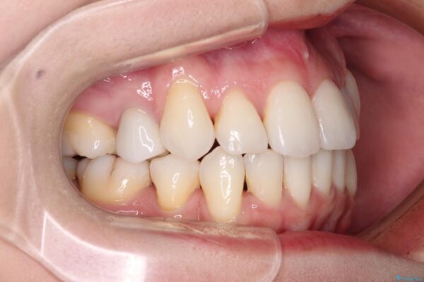 結婚式までに前歯をきれいにしたい　抜歯矯正とオールセラミッククラウン 治療後画像