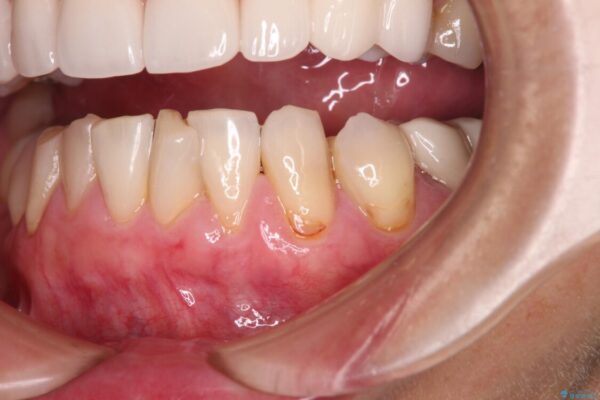 歯磨きの度にしみる歯　露出した歯根を歯肉移植で改善 ビフォー