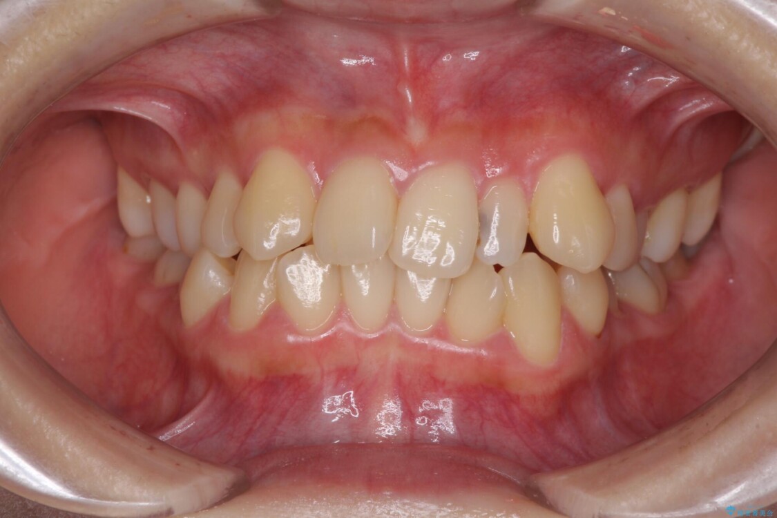 八重歯の抜歯矯正　補助装置を用いたインビザライン矯正 治療前