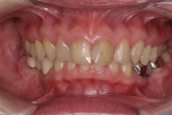 割れてしまった奥歯をインプラントで　気になる銀歯もセラミッククラウンで審美的に 治療前画像
