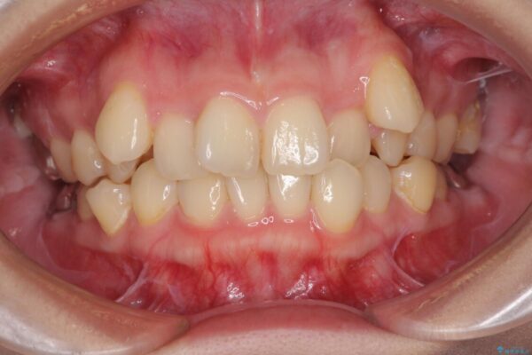 上顎の八重歯と下顎前歯の欠損　ワイヤー装置による抜歯矯正 ビフォー