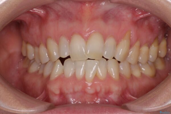 前歯のスペースが気になる　インビザラインによる矯正治療 ビフォー