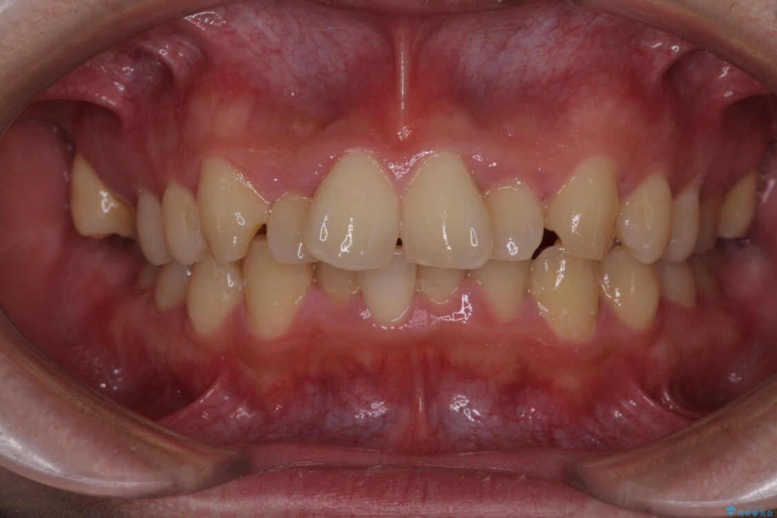 強い咬み込みですり減った前歯　デコボコを抜歯矯正で整える 治療前