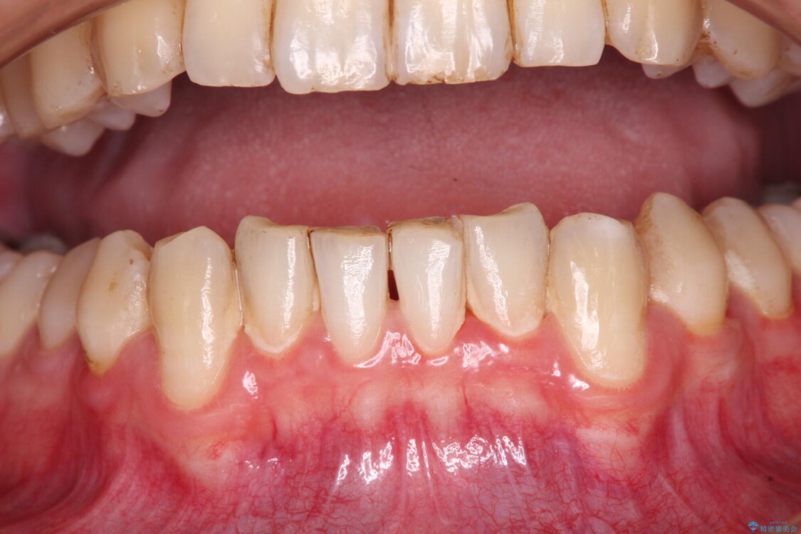 しみてしまう下顎の犬歯　歯肉移植による根面被覆 治療前