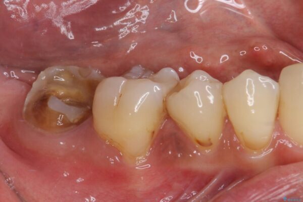 もげてしまった奥歯　部分矯正で清掃性の良い補綴治療 治療前画像