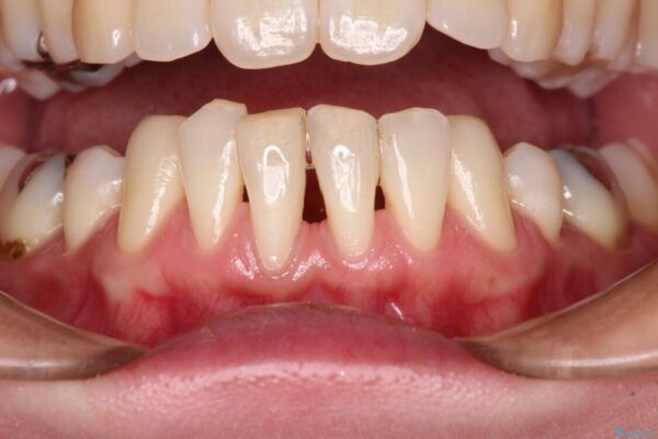 下顎前歯の歯肉退縮　歯肉移植による根面被覆 ビフォー