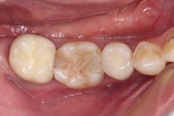 奥歯がしみる　色々な国で治療を受けてきた奥歯のむし歯治療 治療前画像